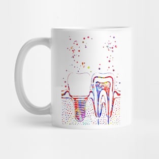 Human teeth and dental implant, Mug